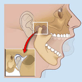 Jaw Muscle Pain